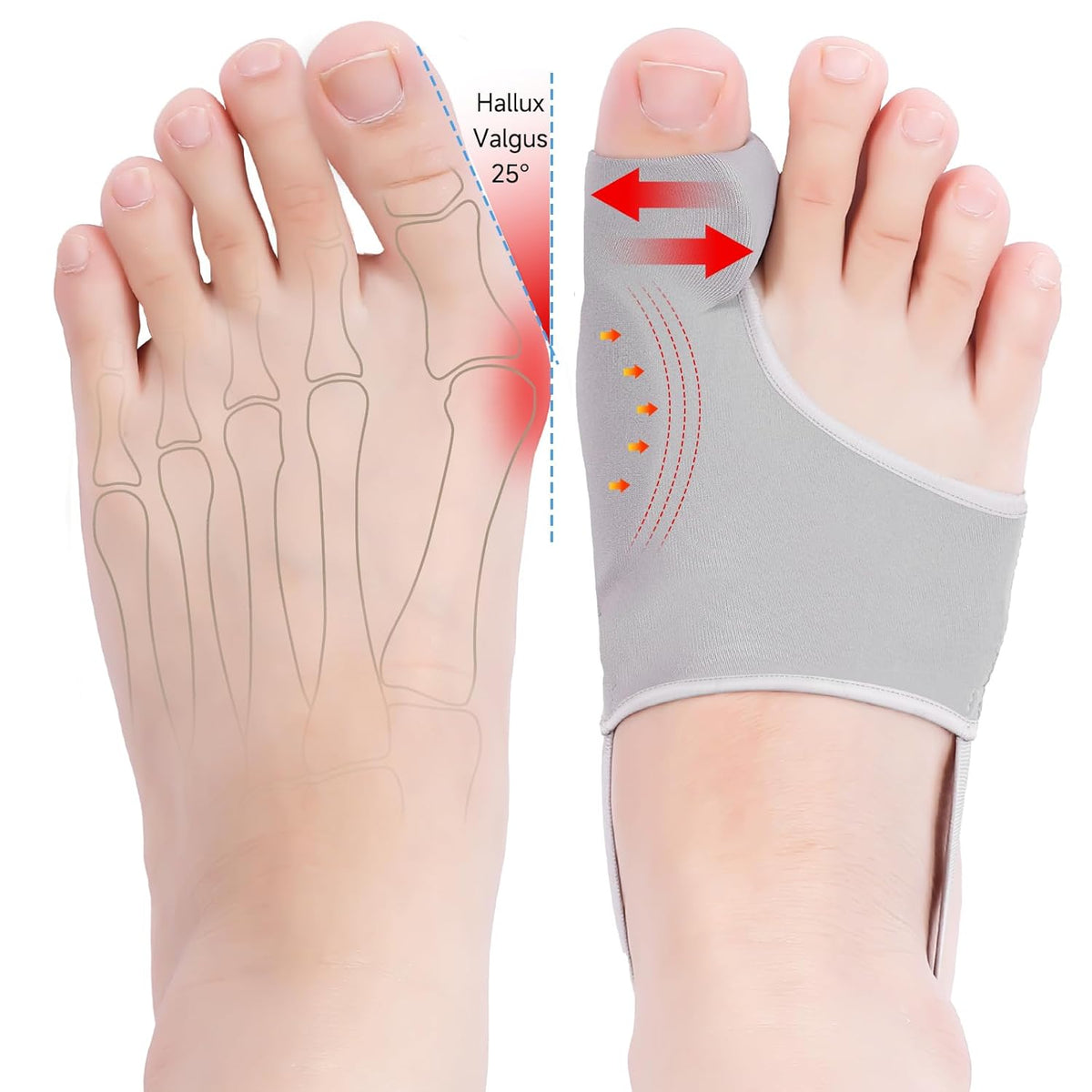 HYGGEAR CORRECTOR DE JUANETES Y HALLUX VALGUS PARA DEDO GORDO DEL PIE
